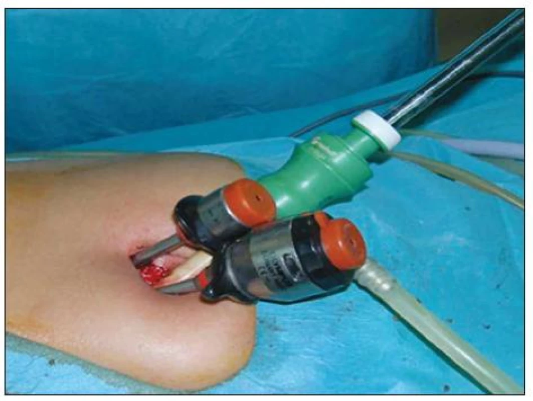 Instrumentárium SILS
Fig. 1. SILS instrumentation