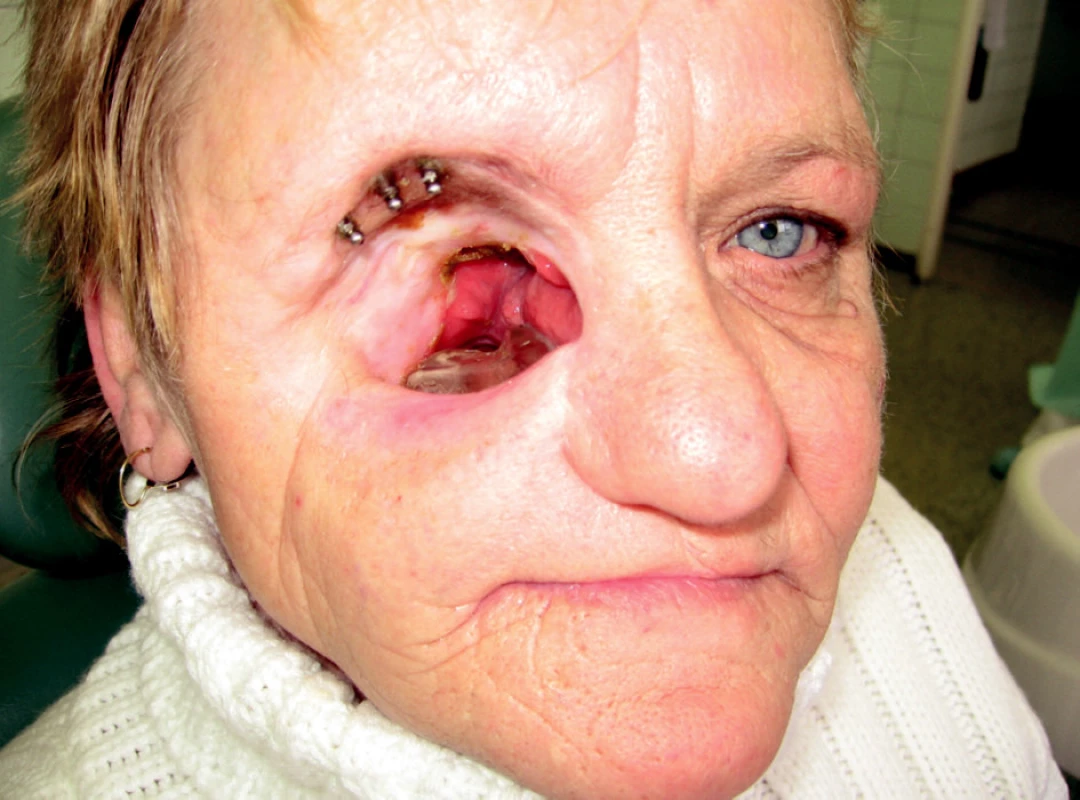 Rozsáhlý defekt střední obličejové etáže, obturační horní celková náhrana in situ, v margo supraorbitalis se nacházejí tři válcové implantáty s kulovými attachmenty.