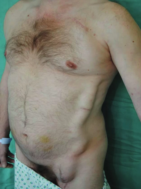 Perigraft seroma around left-sided axillofemoral bypass (standing position)