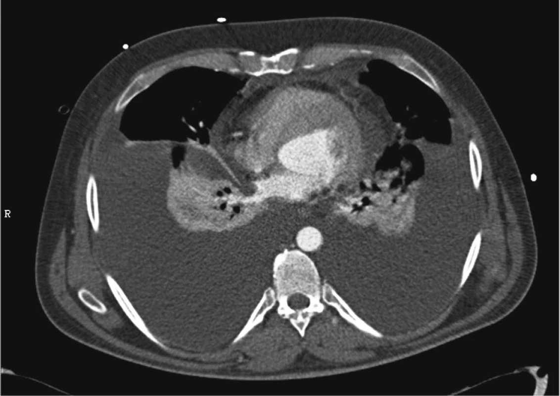 CT – oboustranný fluidotorax, prosáknutí mediastina
Fig. 3. CT scan – bilateral fluidothorax, mediastinal effusion
