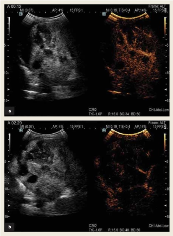 Kontrastná ultrasonografia pečene (CEUS) – pravá časť obrázka, oranžové sfarbenie:
a) arteriálna fáza – periférna časť abscesového ložiska a septá s hyperintenzívnym sig- nálom, výpadok signálu kontrastnej látky v hypoechogénnych oblastiach ložiska,
b) neskorá a portálna fáza – postupné zoslabovanie signálu kontrastnej látky v perifér- nych častiach a septách ložiska.
Fig. 2. Contrast-enhanced ultrasound (CEUS) – right part of figure, orange coloring:
a) arterial phase – a hyperintense signal of the contrast agent in the peripheral parts of the focus and in the intralesional sept, with signal drops in the hypoechoic areas of the focus, b) late and portal phase – gradual weakening of the signal of the contrast agent in in the pe- ripheral parts of the focus and in the intralesional sept.