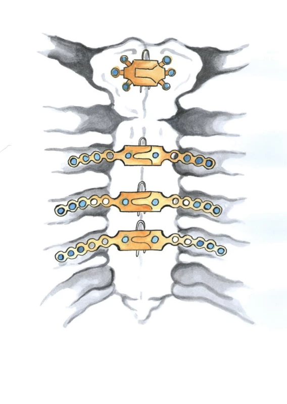 Dlahová osteosyntéza sterna (Kresba archiv autora)
Fig. 10: Sternal plating system