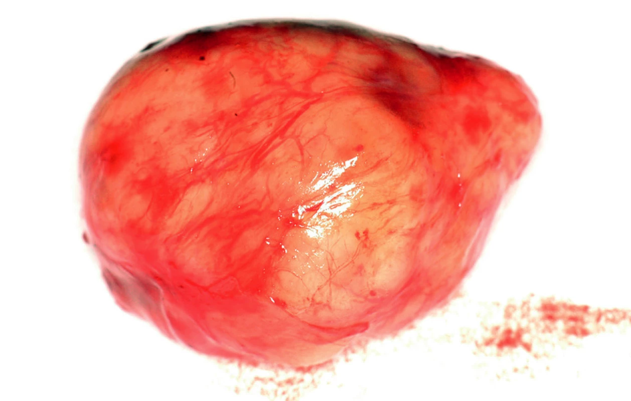 Exstirpovaná rezistence
Fig. 4. The tumor specimen