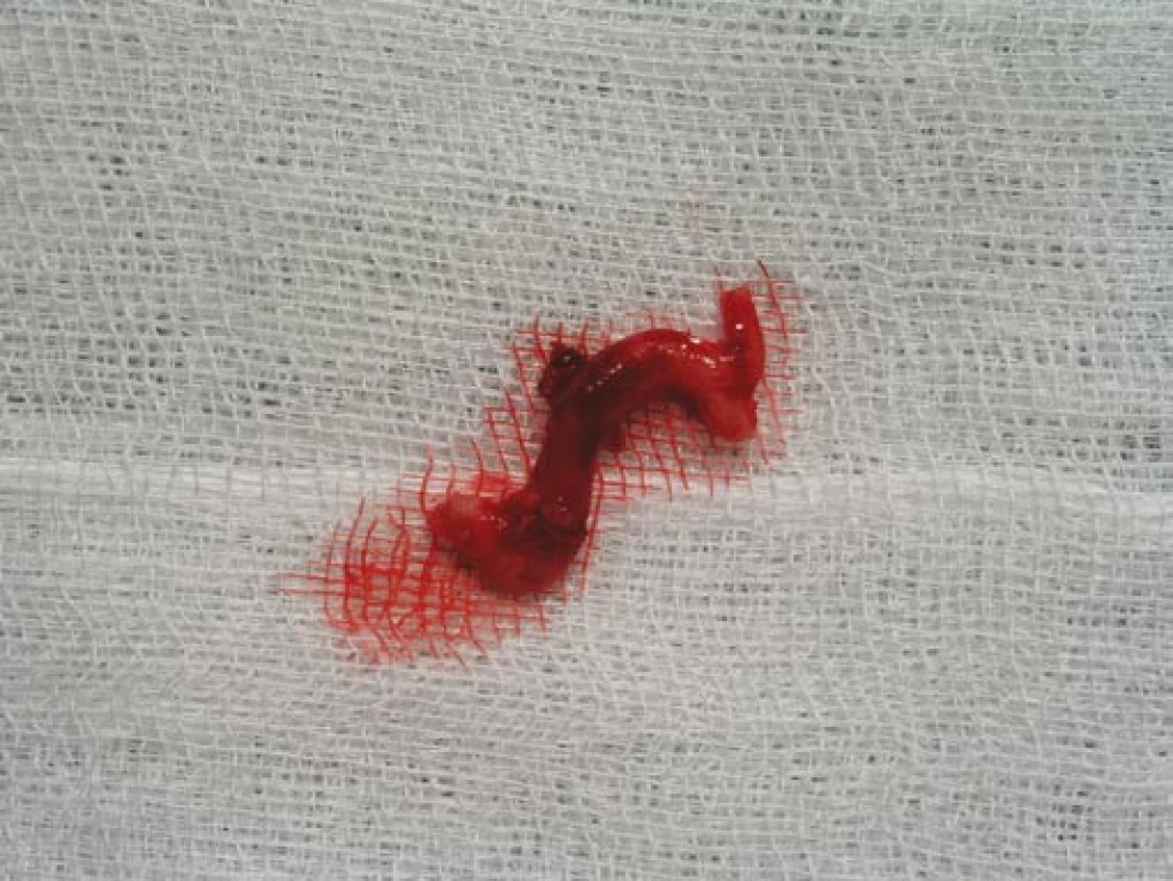 Excidovaná větev temporální arterie v délce 4 cm odeslaná k histologickému vyšetření.