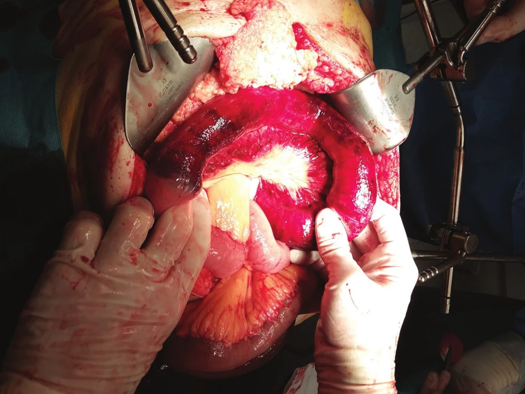 Perioperační nález
Fig. 3: Perioperative finding