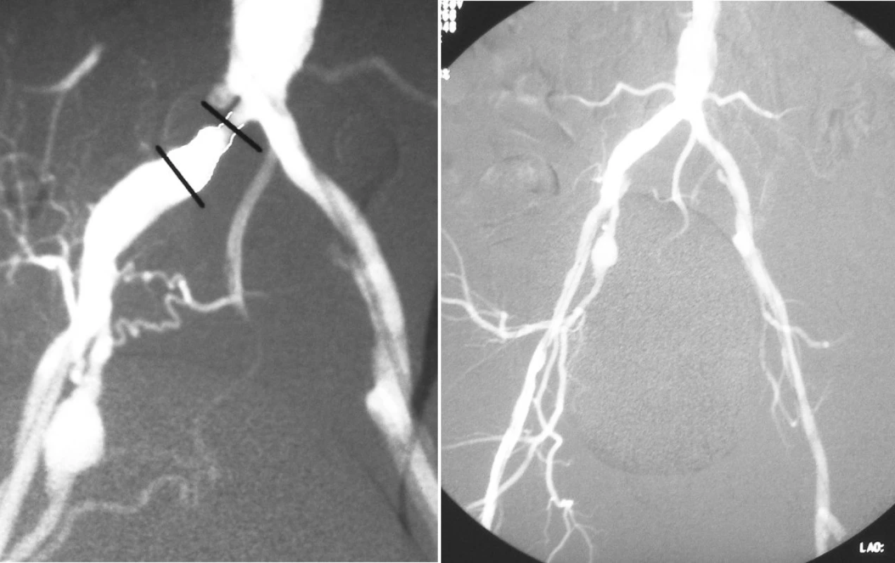 a, b. DSA vyšetrenia pacient č. 3, a) kritická odstupová stenóza arteria iliaca communis vpravo 1 cm dlhá s postenotickou dilatáciou. Na arteria iliaca interna vpravo 1 cm po jej odstupe je aneuryzma 1,9x1,3 cm. Vľavo ľahká stenóza arteria iliaca communis v periférnej časti s podmínovaným okrajom. Odstupový uzáver arteria iliaca interna vľavo b) stav po perkutánnej transluminálnej angioplastike arteria iliaca communis vpravo s implantáciou stentu
Pic. 6 a, b. DSA examination - Patient Nr. 3, a) critical stenosis of the common iliac artery branch on the right, 1cm long with poststenotic dilation. An aneurysm measuring 1.9x1.3 cm is located on the internal iliac artery, 1 cm after its branching. Mild peripheral stenosis of the left common iliac artery with its edge undermined. Branch closure of the left internal iliac artery b) status following percutaneous transluminary angioplasty of the right common iliac artery with a stent implantation