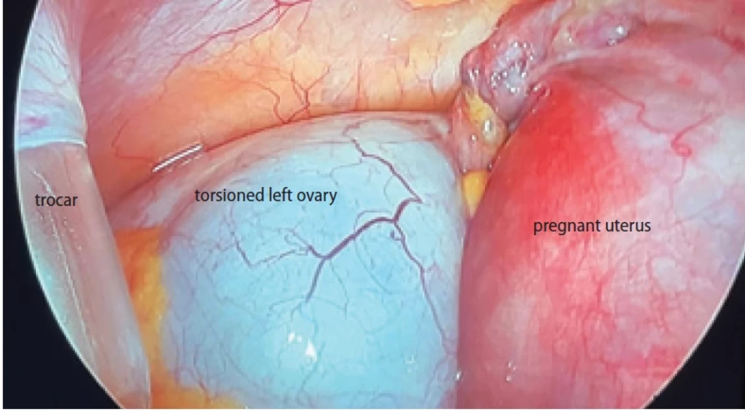 Left ovarian torsion due to ovarian cyst at 26 weeks of gestation. Obr. 1. Torze levého vaječníku způsobené ovariální cystou ve 26. týdnu těhotenství.