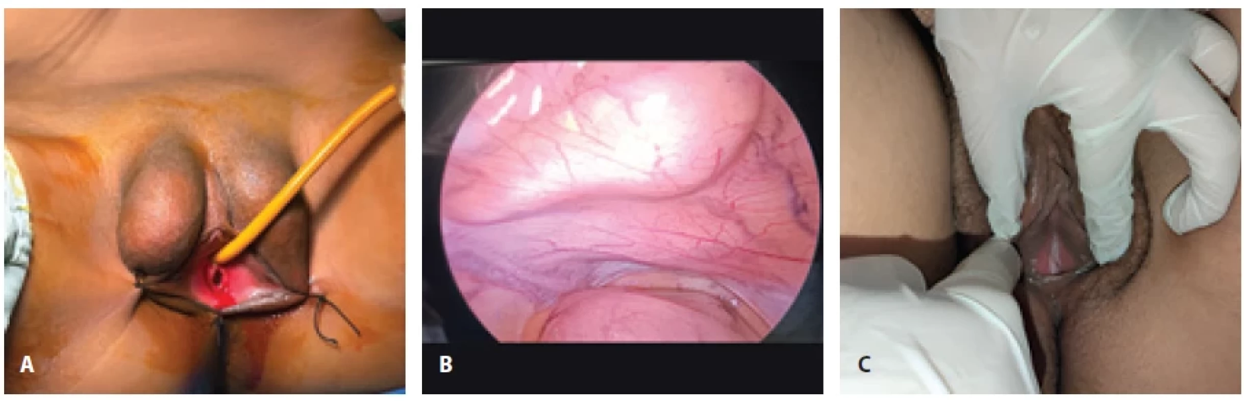 A) Pre-op image – absent vagina and testicular bulge in the right labia; B) intra-operative laparoscopy showing absent uterus and ovaries; C) post Mc Indoe’s vaginoplasty.