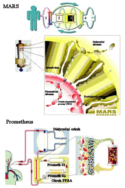 Schematické znázornění principu eliminace v systému MARS® a Prometheus® (převzato z informačního letáku).
Fig. 4. Schematic imaging of the MARS® and Prometheus® system elimination principles (adopted from their information leaflets).