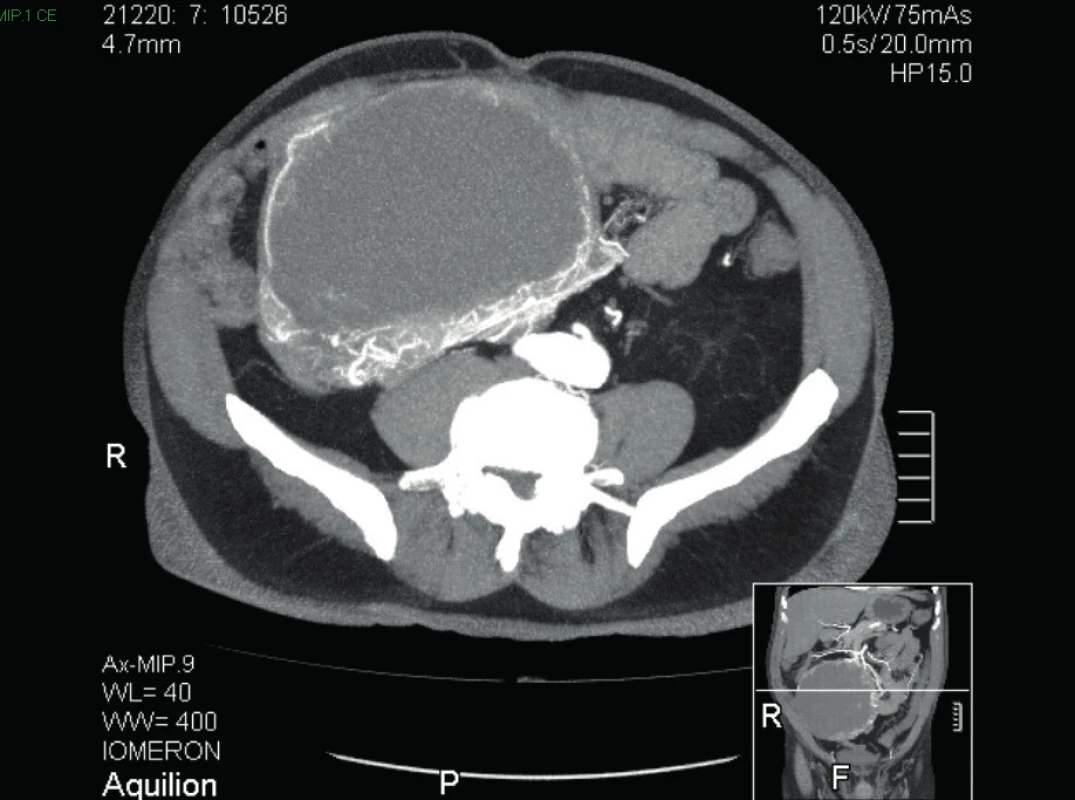 CT břicha a malé pánve MIP (maximum intensity projection ) v axiální rovině
Fig. 4: CT scan of abdomen and pelvis MIP (maximum intensity projection ) axial view