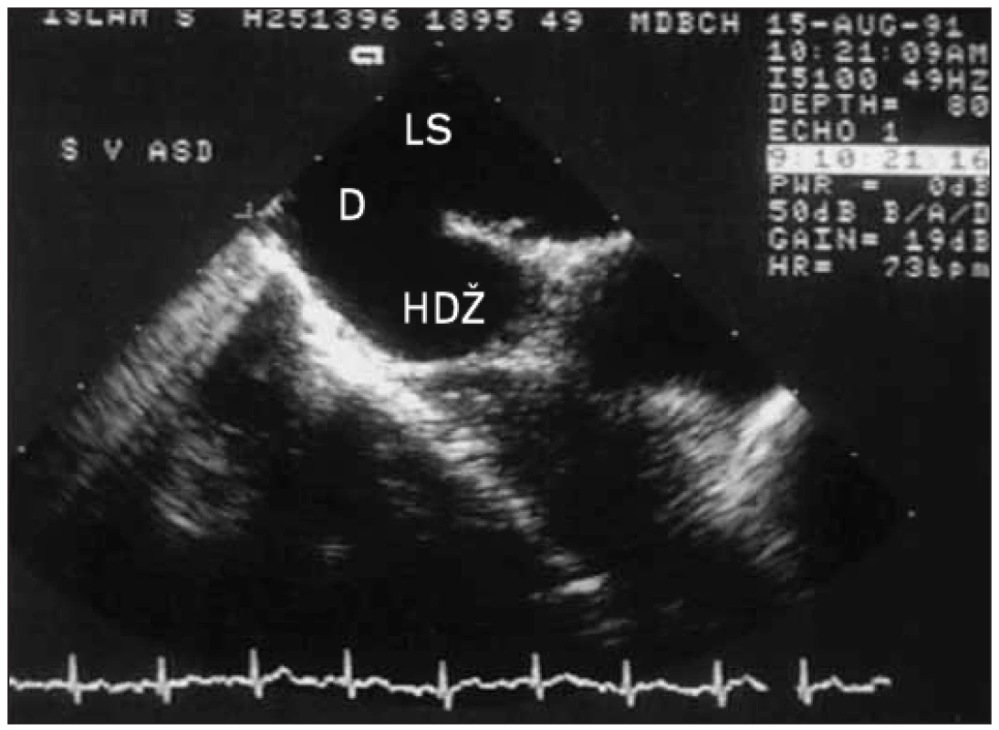 Transezofageální obraz ukazuje defekt septa síní typu sinus venosus přímo na vrcholu síňové přepážky v místě vstupu horní duté žíly. Protože tato oblast nemůže být běžně znázorněna transtorakálně (s výjimkou dětí), mohou být takové defekty zobrazeny pouze transezofageální technikou.