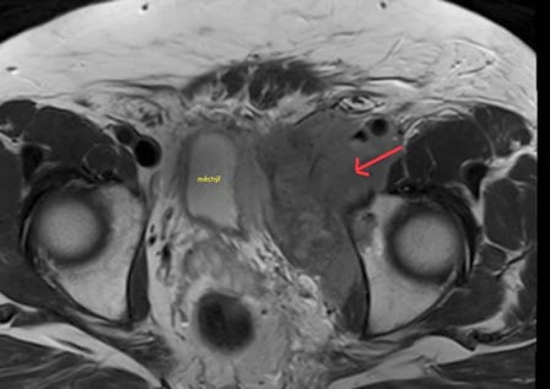 Magnetická rezonance pánve – expanze v oblasti levé poloviny malé pánve v těsném kontaktu s močovým měchýřem a s jeho dislokací napravo
Fig. 4. Magnetic resonance imaging of the pelvis – expansion in the left part of the pelvis in close contact with bladder wall and dislocation the bladder to the right