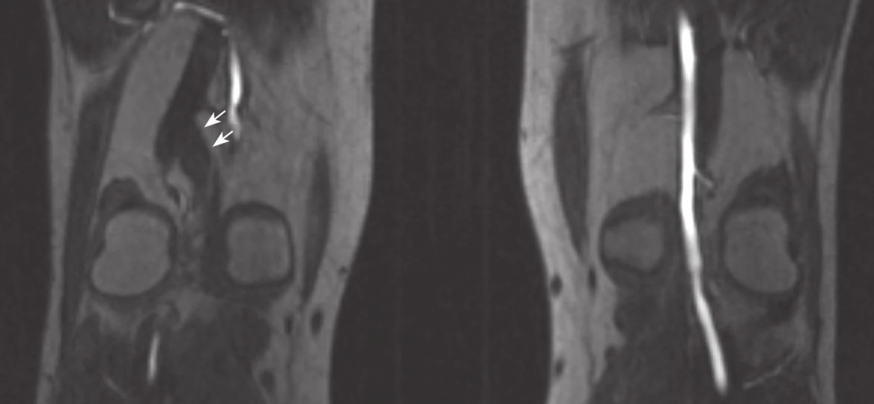 Pacient 2
Magnetická rezonance prokazující pravostranný entrapment syndrom arteria poplitea III typu; bílé šipky − akcesorní svalový pruh.
Fig. 3: Patient 2
Magnetic resonance imaging demonstrating right sided popliteal artery entrapment syndrome type III; white arrows − accessory muscle slip.