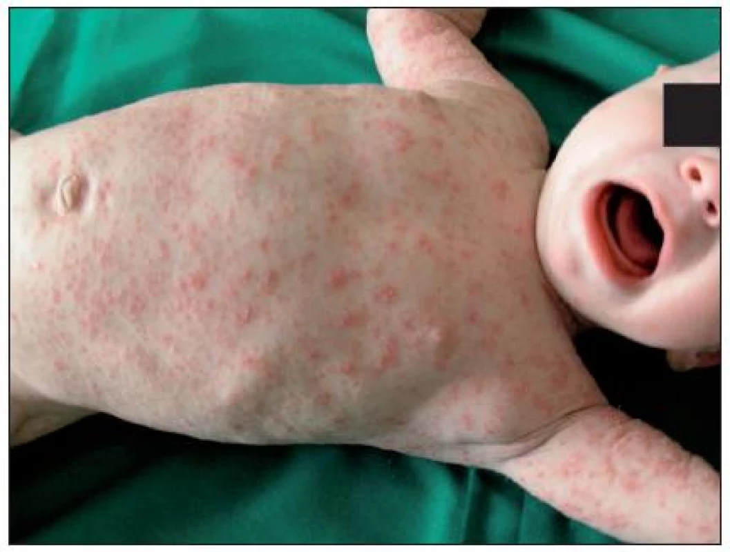 Scabies crustosa generalizované prejavy (Danilla T.)