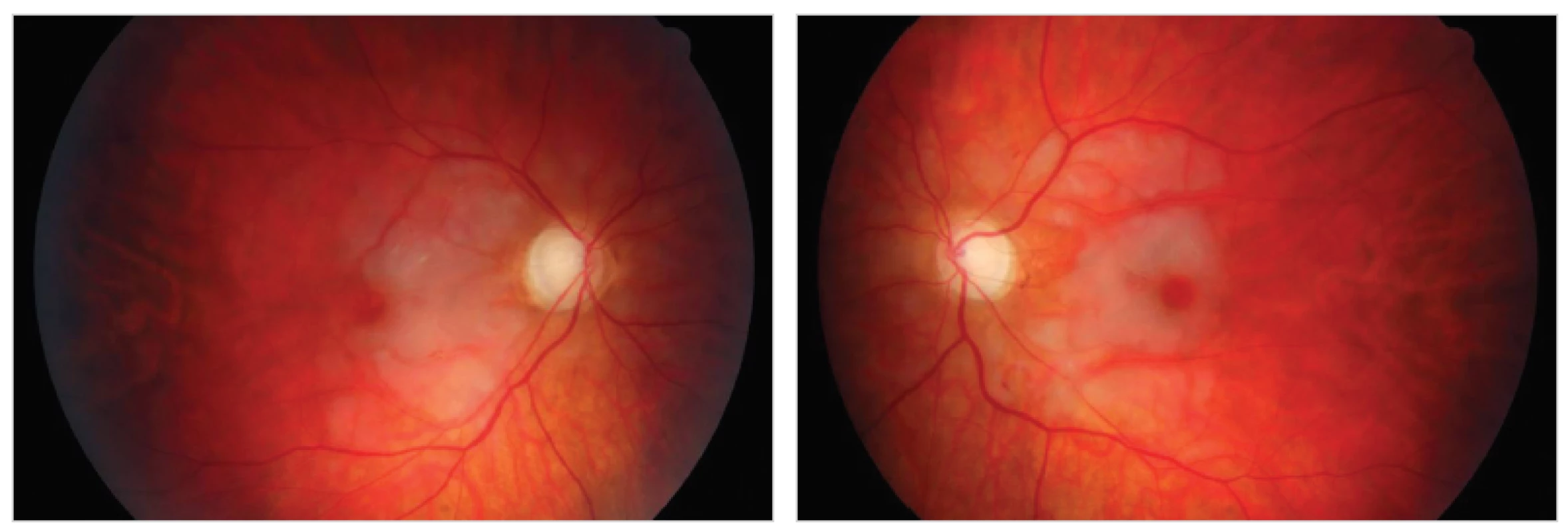 Foto očného pozadia oboch očí s viditeľnou ischémiou v makule a chýbajúce drobné cievy na terči zrakového nervu (TZN)
Fig. 1: Photographs of the retinal background of both eyes with visible macular ischemia and lacking small vessels in the optic disc