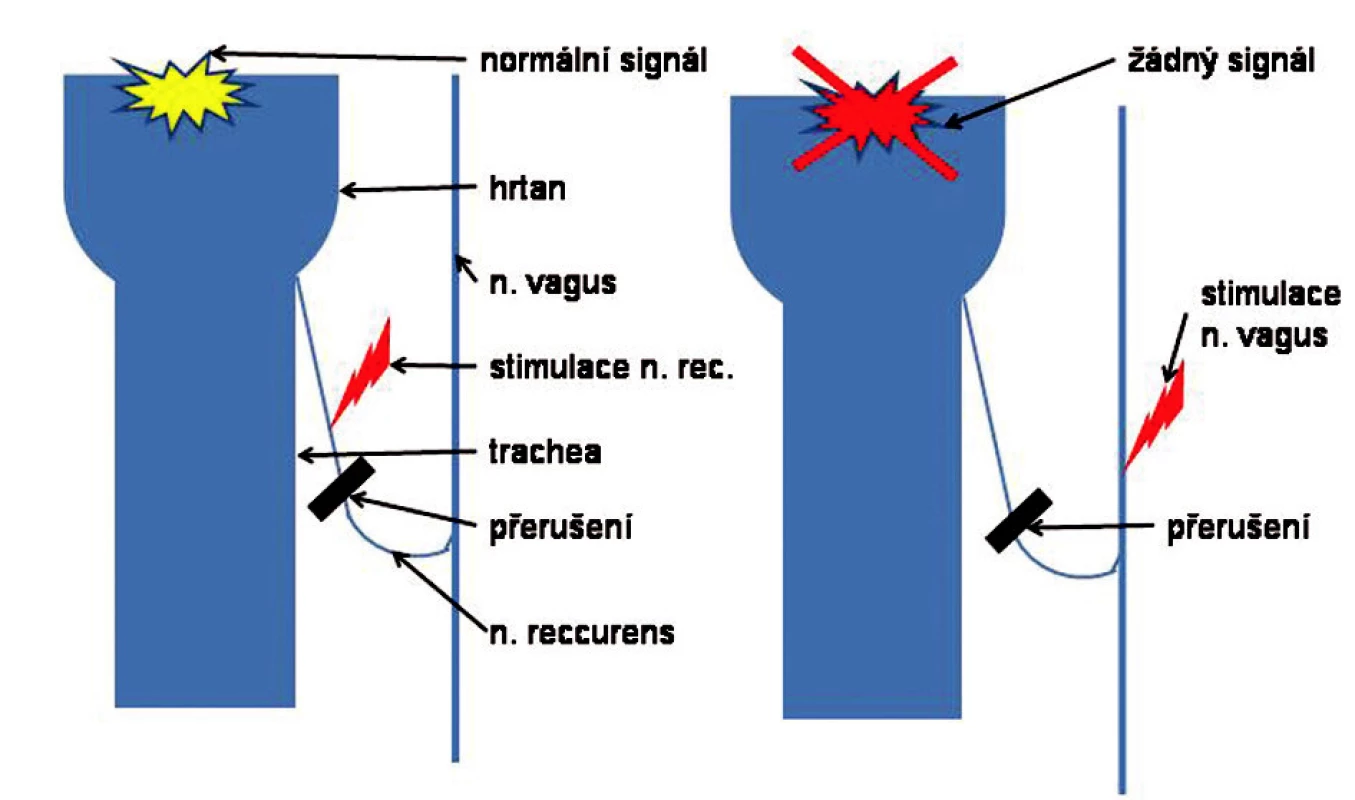 Význam místa stimulace při neuromonitoringu
Fig. 9. Significance of the stimulation site in neuromonitoring