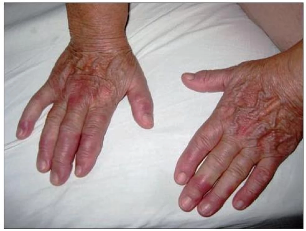 Erythema elevatum diutinum – dorzálna strana rúk