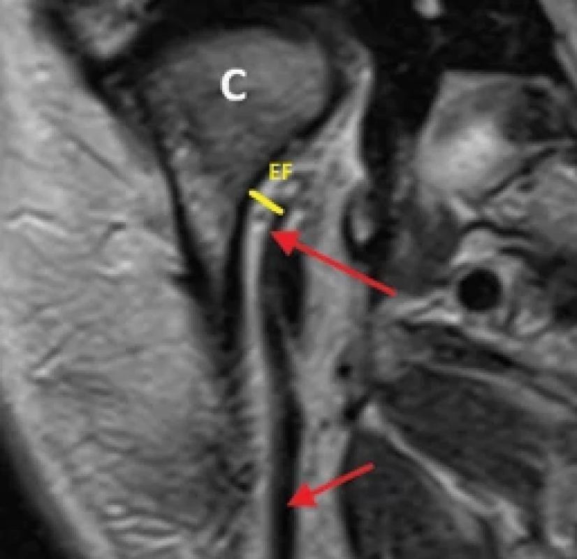 MRI of the of the temporomandibular joint, coronal view.