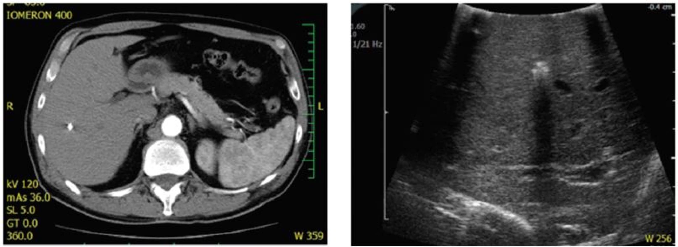 Predliečebné označenie rizikových CRLM (hlboko uložené, priemer pod 2 cm)
a) CT obraz po absolvovaní iniciálnej chemoterapie v režime XELOX. Kompletná rentgenologická odpoveď ; b) Lokalizácia “zmiznutej metastázy” prostredníctvom peroperačnej ultrasonografie.
Fig. 1: Pretreatment identification of high-risk lesions (deeply localised, with less than 2 cm in diameter)
a) CT scan after preoperative XELOX chemotherapy. Complete radiological response; b) Localization of the “disappearing” lesion by intraoperative ultrasound.