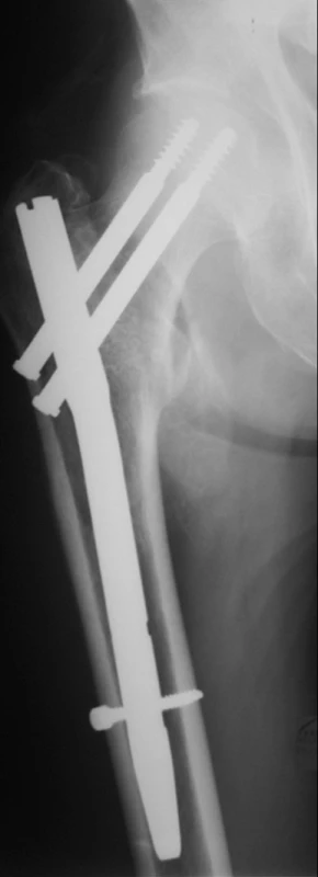 Osteosyntéza nestabilní pertrochanterické zlomeniny distálně zajištěným hřebem: a – nestabilní tříúlomková pertrochanterická zlomenina s velkým dorzálním fragmentem a longitudinální instabilitou; b – 3 měsíce po operaci zlomenina zhojena, je patrné, že došlo ke kompresi v linii lomu (změna postavení zajišťovacího šroubu v otvoru pro dynamické zajištění).
Fig. 5: Nailing of unstable pertrochanteric fracture with distal locking: a – unstable threefragment pertrochanteric fracture with a large posterior fragment and a longitudinal instability; b – 3 months after the procedure with healed fracture, a compression within the fracture line is visible (a change in the position of the distal locking screw within the dynamic locking hole).