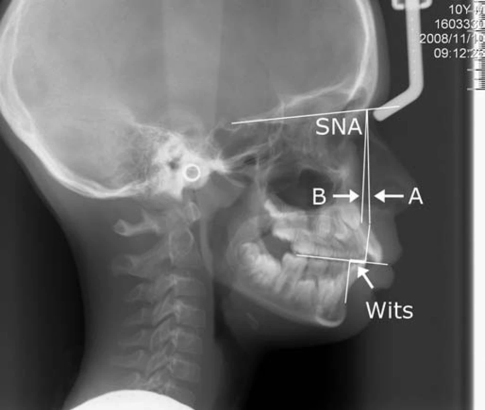 Bočná kefalometrická snímka pacienta č. 3. Znázornený je parameter Wits a uhol SNA. A – aktuálna hodnota uhla SNA, B – fyziologická hodnota uhla SNA
Fig. 6. Lateral cephalometric X-ray of patient No. 3. The parameters Wits and SNA angle are visualized. A – actual value of SNA angle, B – physiological value of
SNA angle
