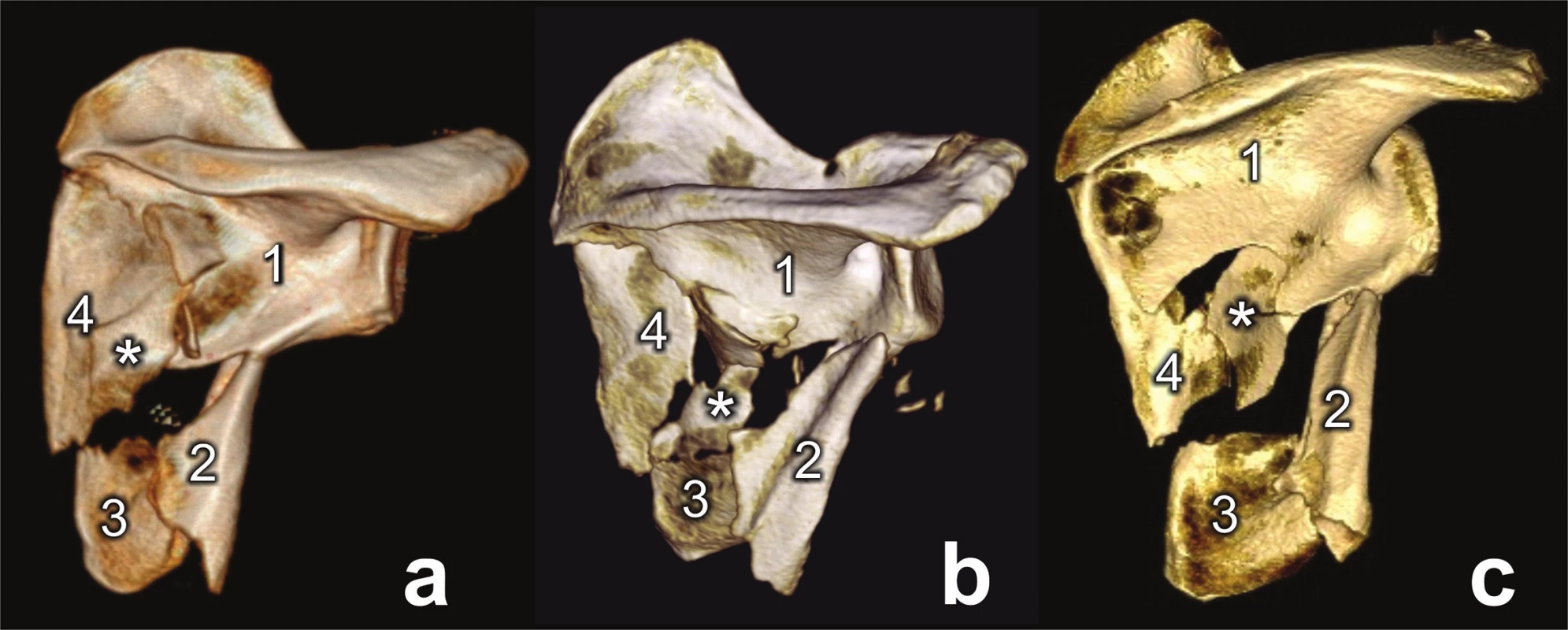 Types of comminuted fracture of lateral pillar (a, b, c)
1 – glenoid fragment, 2 – lateral border fragment, 3 – inferior angle fragment, 4 – medial border fragment, * - intercalary fragment.