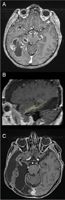MR 10 let žijící pacientky s glioblas tomem, operované v 58 letech (3 operace,  radiochemoterapie, boost gama nožem).  (A) Předoperační MR zobrazuje multiloku laritu tumoru. (B) Zaměření boostu gama  nožem na strop postresekční dutiny. (C)  MR po 10 letech bez recidivy.  Fig. 2. MRI of a female patient with glio blastoma with 10-year overall survival,  operated on at 58 years of age (3 surge ries, radiochemotherapy, gamma knife  boost). (A) Pre operative MRI shows the  multilocularity of the tumor. (B) Focus of  the gamma knife boost on the upper side  of the post-resection cavity. (C) MRI after  10 years without recurrence.