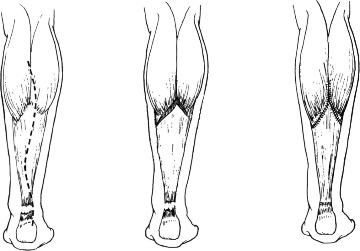 Plastika dle Abrahama a Pankovitcha [1]
(Volně podle Abraham, E., Pankovich, A.M. Neglected rupture of the Achilles tendon: treatment by a V-Y tendinous flap. J Bone Joint Surg Am. 57, 253– 255, 1975)