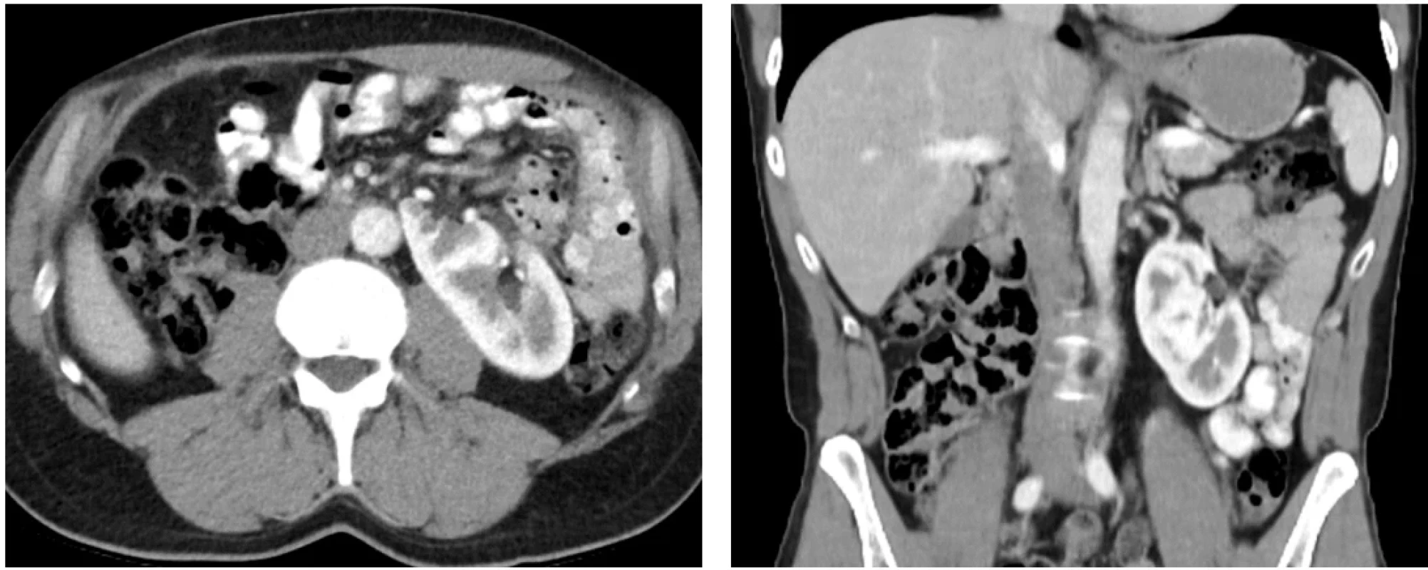CT břicha s kontrastní látkou v transverzální a koronární projekci 3 roky od započetí léčby. Fig. 5. Contrast-enhanced abdominal CT in transverse and coronal planes performed three years after initiation of treatment.