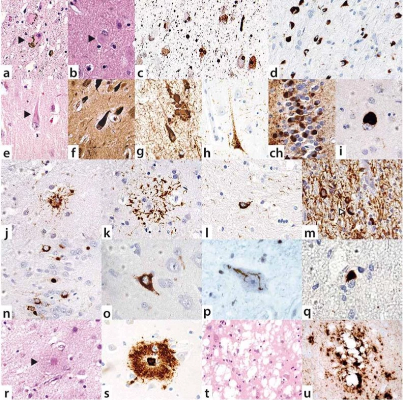 Neuropatologické markery neurodegenerací.