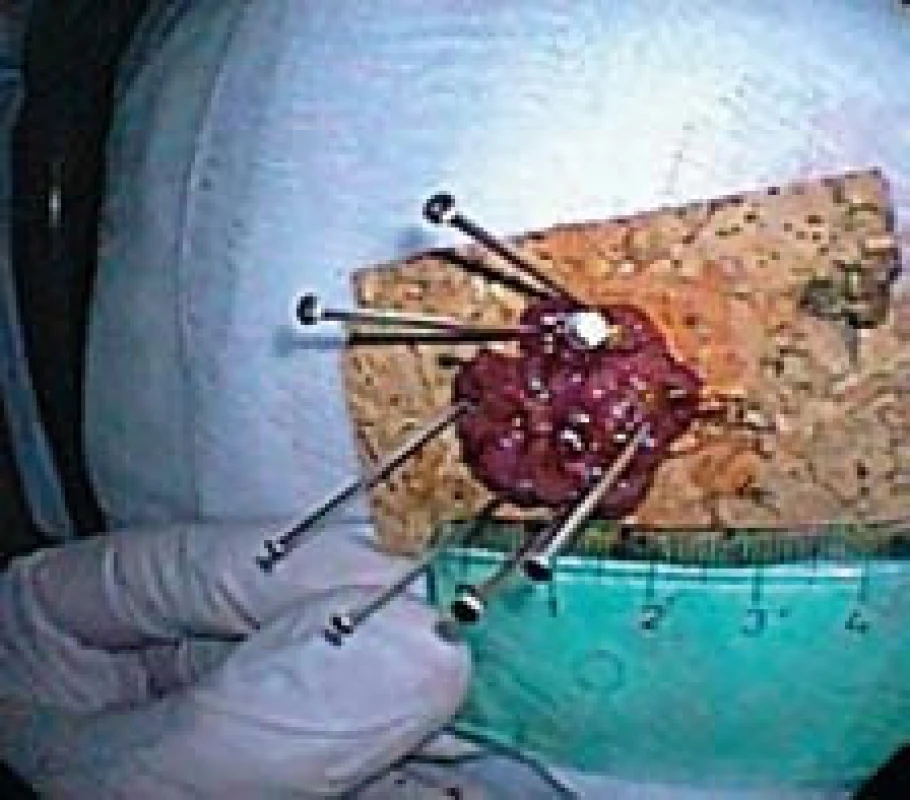 Resekát na korkové podložce.
Fig. 5. Resected specimen stretched on a corc board.