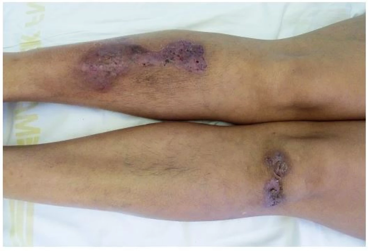 Hojící se projevy pyoderma gangrenosum u stejné pacientky
