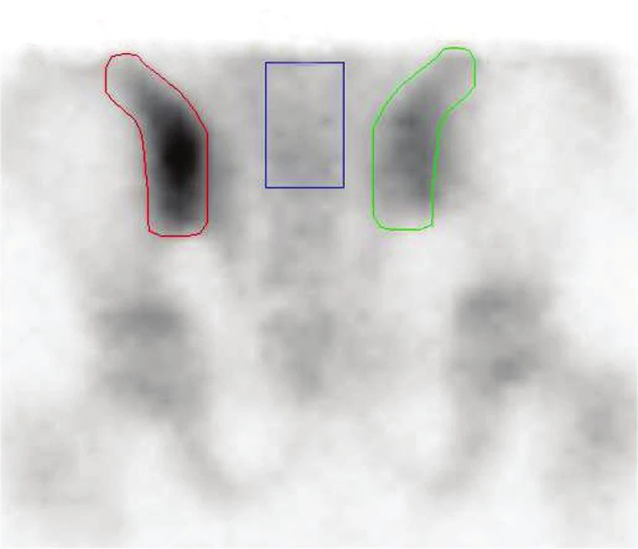 Statický scintigram pánve ze třetí skeletální fáze (PA projekce) se zakreslením ROI levého SI skloubení (A), pravého SI skloubení (B) a os sacrum (C).
Poměr A/C 2,10; B/C 1,47.