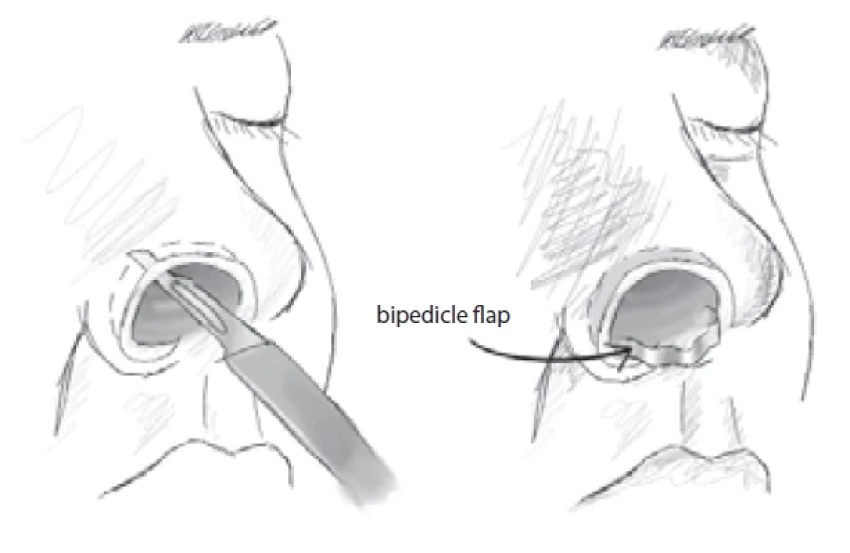 Bridge vestibular fl ap. (Drawing by A. Berkeš according to [2]).