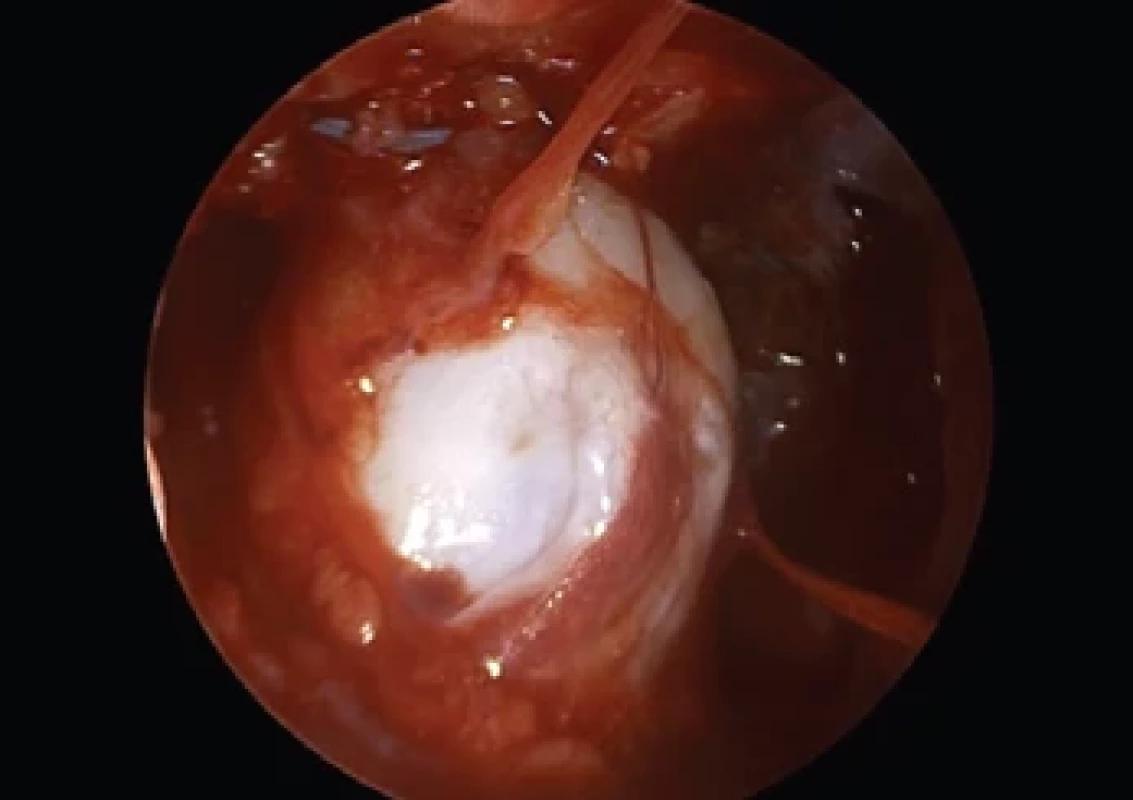 Per operative visualization of the tumor through endoscope – second case.