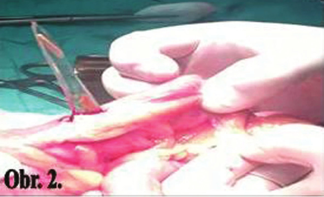 Perforovaná sigma sklom
Fig. 2: Perforation of the sigmoid colon with glass
