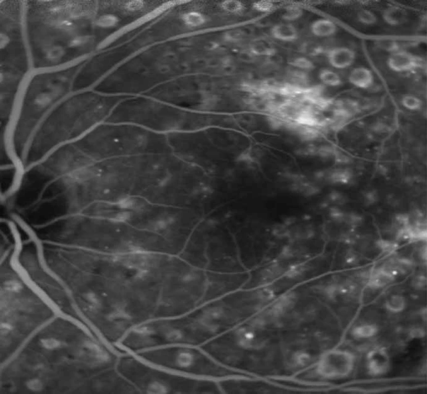 FAG ložisková hyperfluorescence a prosakování kontrastní látky nad makulou před fokální laserkoagulací.