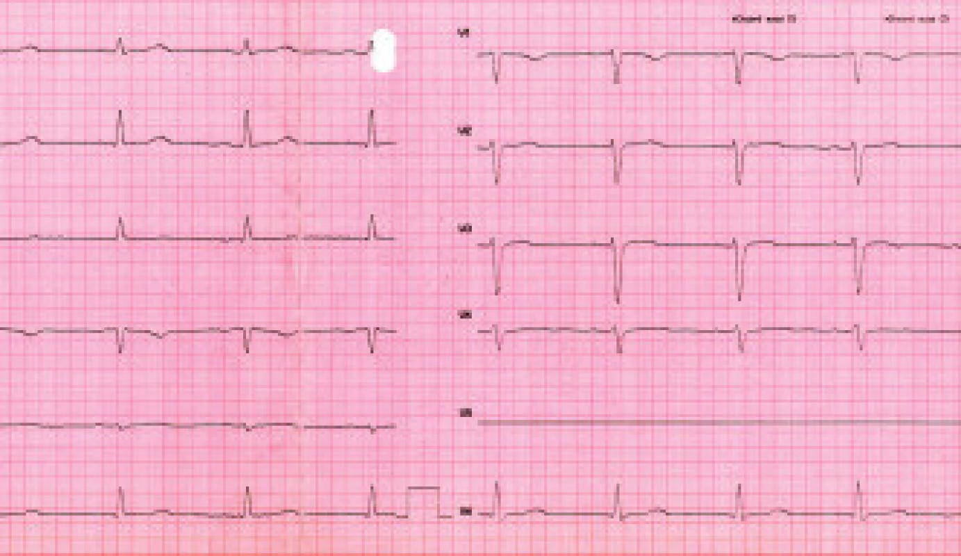 Pri prepustení po 24 hodinách nie sú na EKG prítomné poruchy AV prevodu, ani repolarizačné zmeny (klinický materiál III. internej kliniky LF UPJŠ a FGN L. Pasteura Košice).