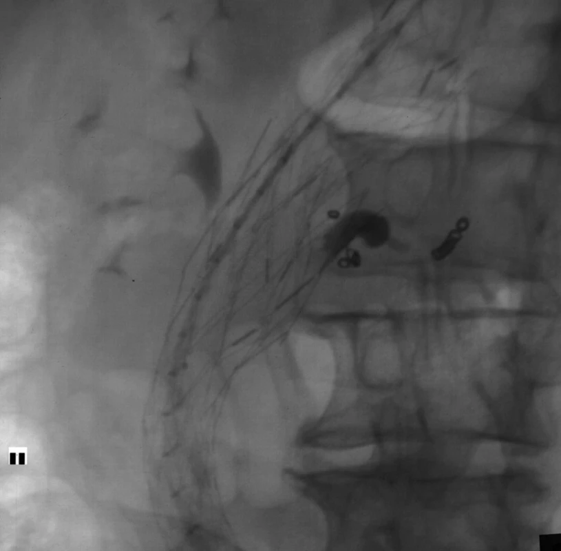 Stav po embolizaci vaku endoleaku směsí histoakrylu a lipiodolu a po embolizaci lumbární tepny spirálkami
Fig. 4. The condition after embolisation of endoleak with mixture of histoacryl and lipiodol and after embolisation lumbar artery with metallic coils