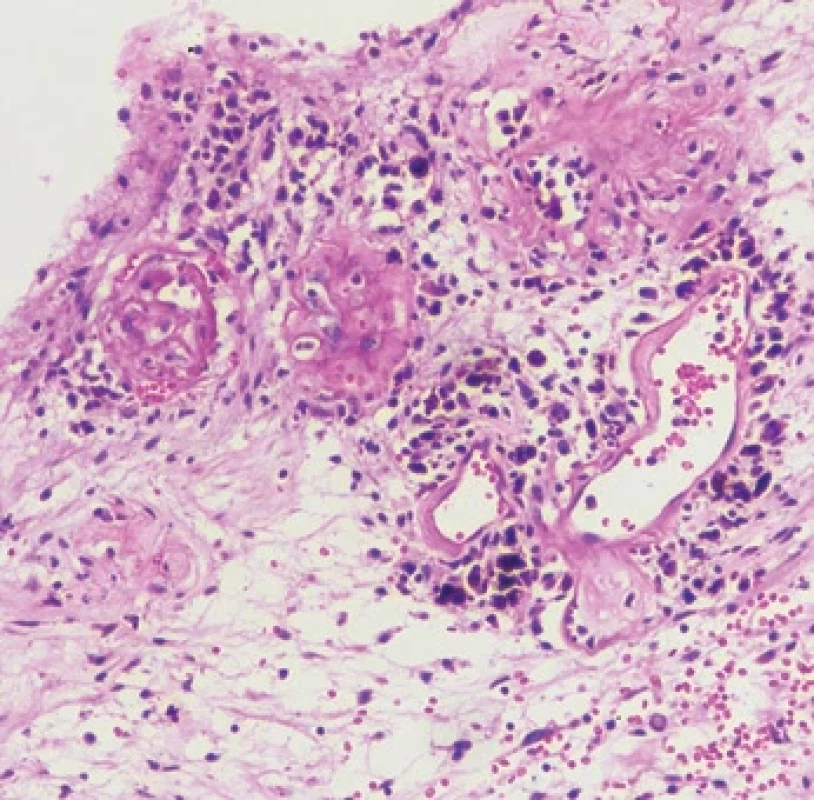 Histopathological examination (hematoxylin and eosin stain with 10× magnifi cation) showing elongated spindle-shaped cells with tapering ends, vesicular nuclei, occasional prominent nucleoli, and a moderate amount of eosinophilic cytoplasm along with Verocay body formation. Multiple areas of dilated cystic spaces and haemorrhage were noted, as well as hyalinized blood vessels and melanin pigment deposits.