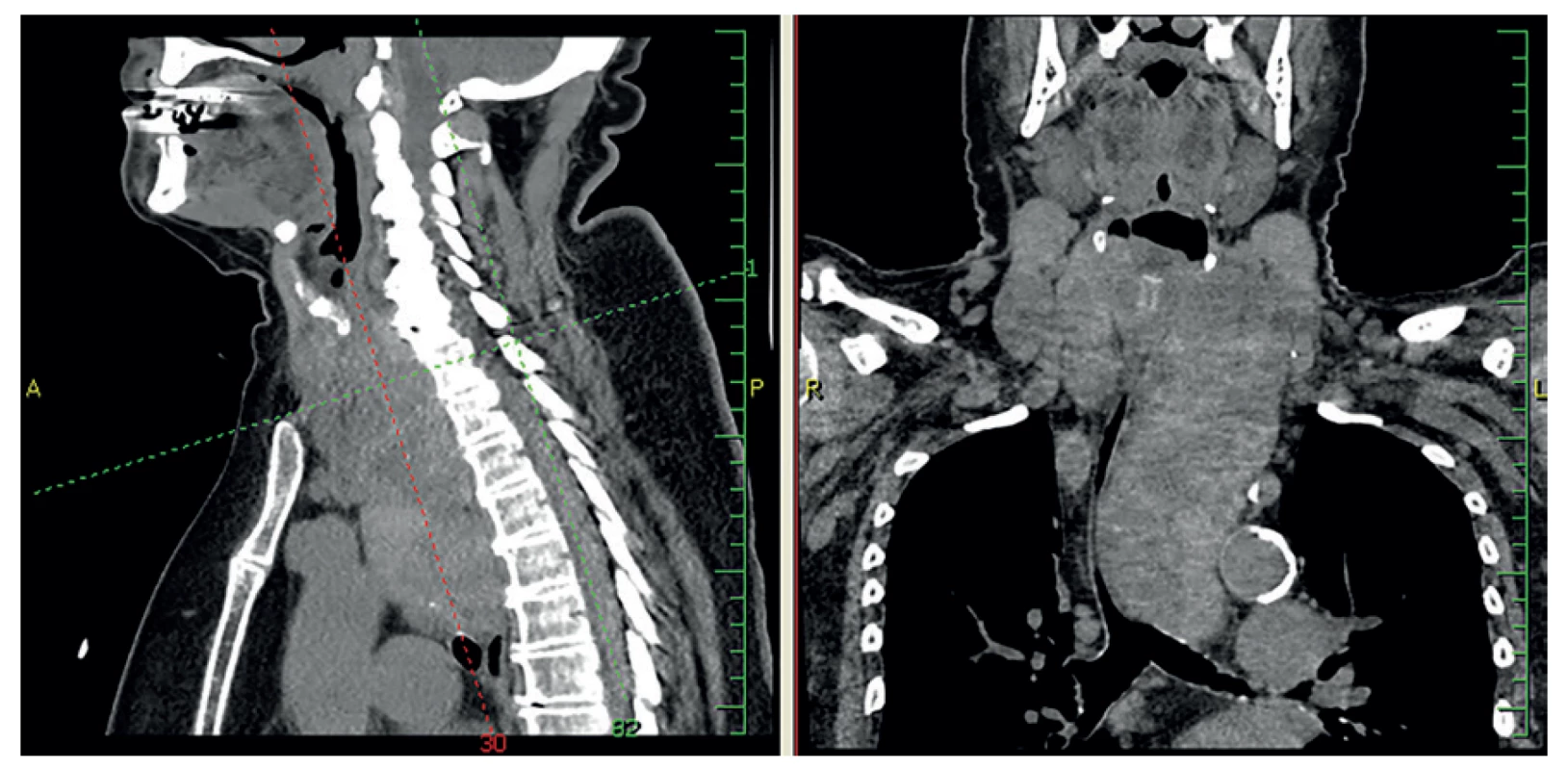Retrosternální struma pod oblouk aorty až k bifurkaci trachey<br>
Fig. 1: Retrosternal goiter below the aortic arch, up to the tracheal bifurcation