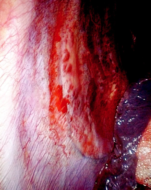 Efekt pleuroabraze smotkem prolenové síťky, vpředu patrná ještě intaktní pohrudnice (operační foto)
Fig. 5. Pleuroabrasion using a prolene mesh tangle. Still       intact pleura is visible in the front. (intraoperative photo)