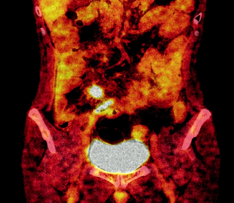 PET/CT 03-2007
Obr. 1. PET/CT 03-2007
Pooperační suspektní recidiva (reziduum) tumoru v pravém mezogastriu, dále podezření na infiltraci stěny ilea v blízkosti tohoto ložiska (píštěl v ráně) zmnožené uzliny v mezenteriu jsou bez výraznější metabolické aktivity.