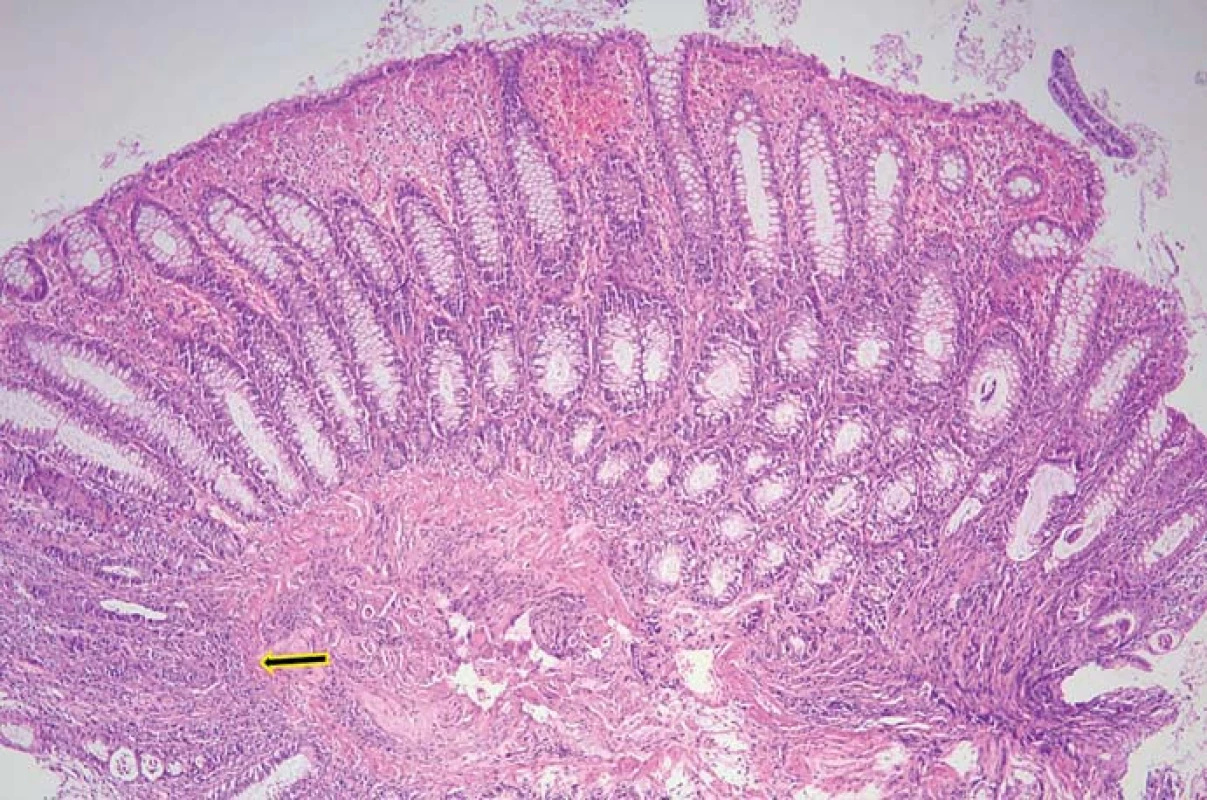 Biopsie v sigmatu s minimální zánětlivou aktivitou, ložiskové překrvení a hemoragie.