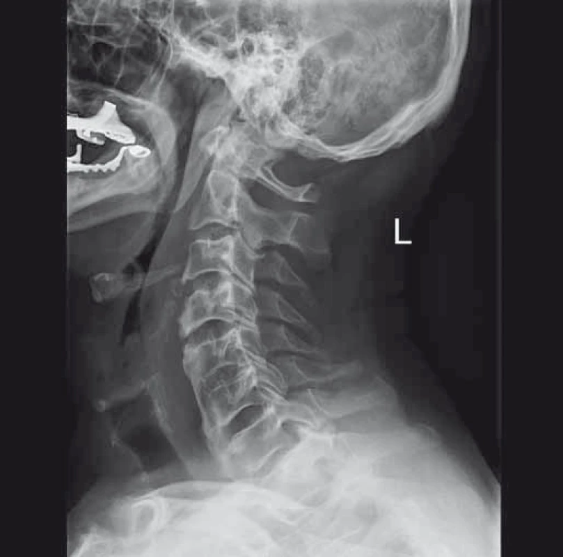 Pooperační RTG po snesení předních osteofytů (kazuistika 2).
Fig. 8. Postoperative X-ray after the ablation of front osteophytes (a case report 2).