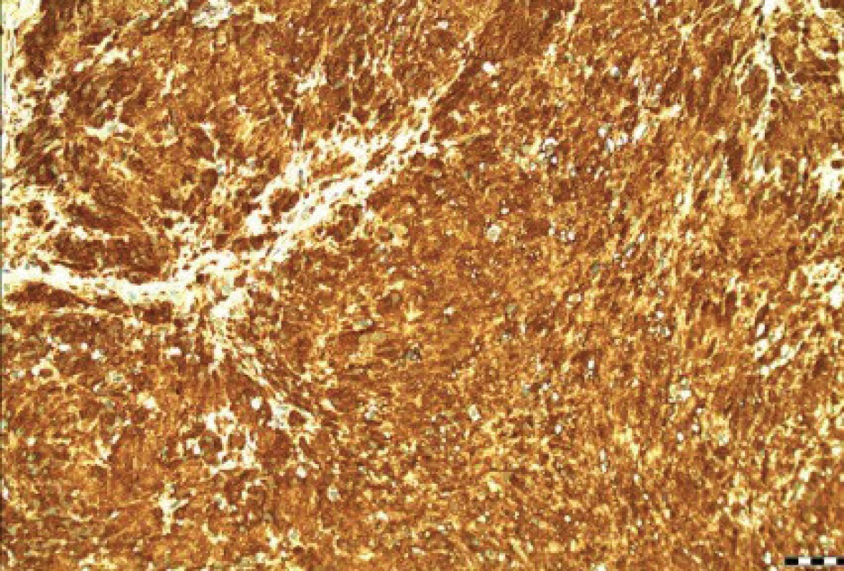 Benígny schwannóm. Imunohistochemický dôkaz S100 (200x).