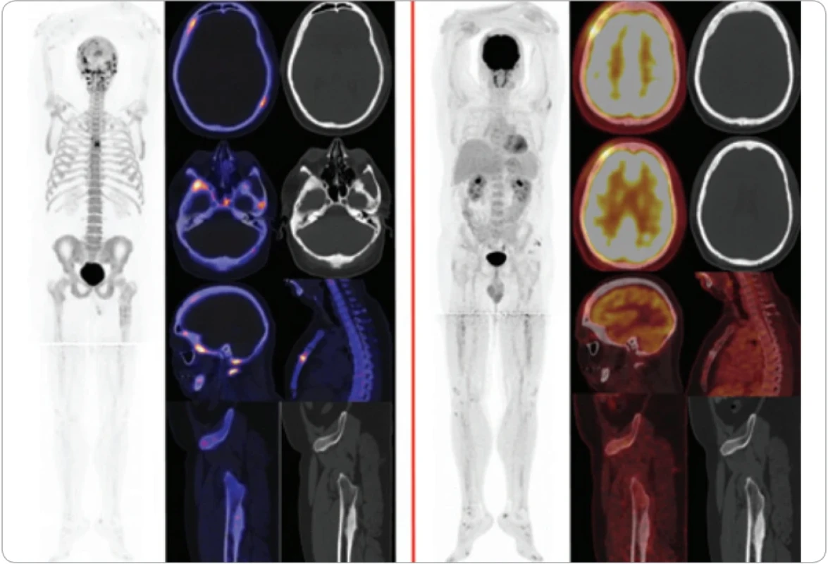Srovnání PET/CT vyšetření s 18F-NaF (vlevo) a 18F-FDG (vpravo).