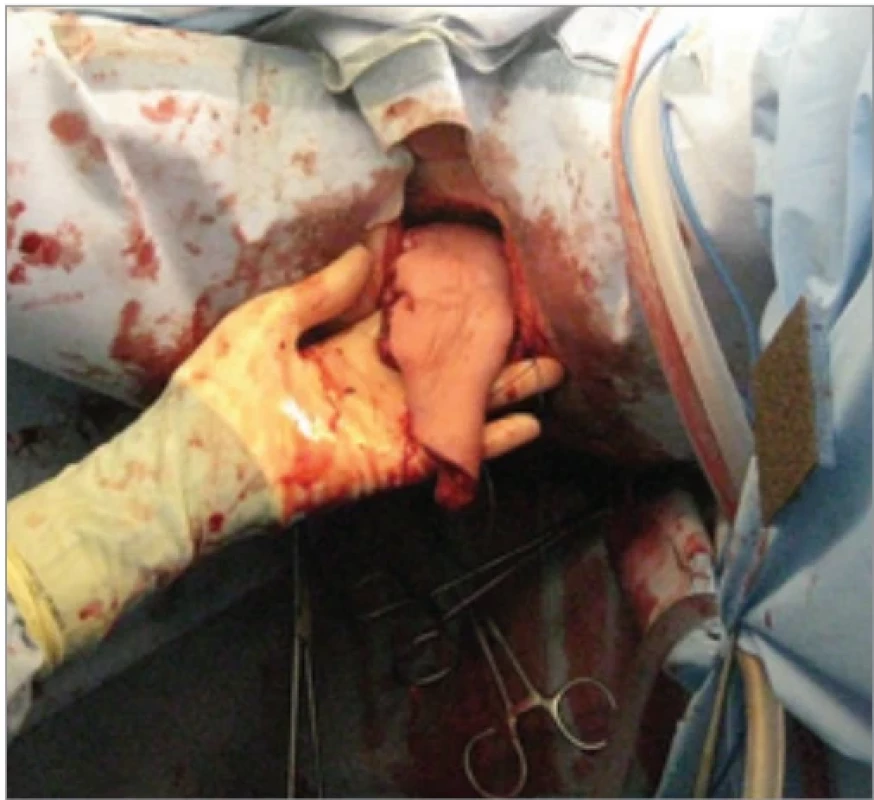 Flap’s position after tunneling to the perineal region. 