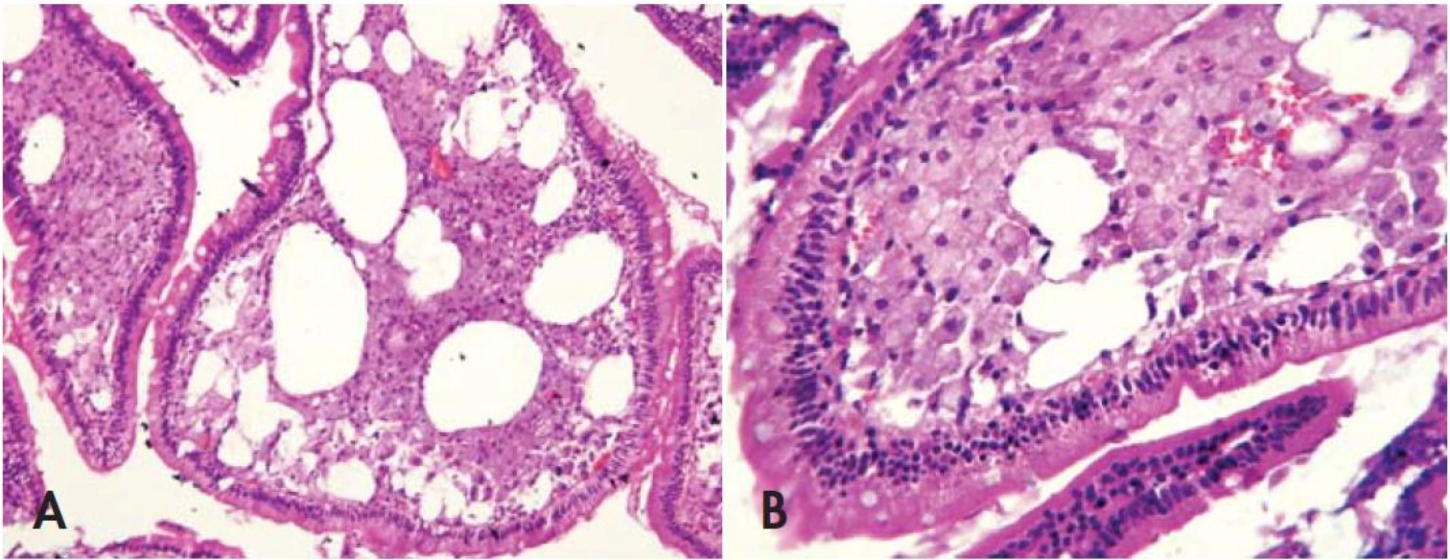 Biopsia duodéna. Kolekcie makrofágov v lamina propria spôsobujúce rozšírenie a otupenie klkov. Hematoxylín-eozín, zvätšenie 100 krát (A) 400 krát (B).