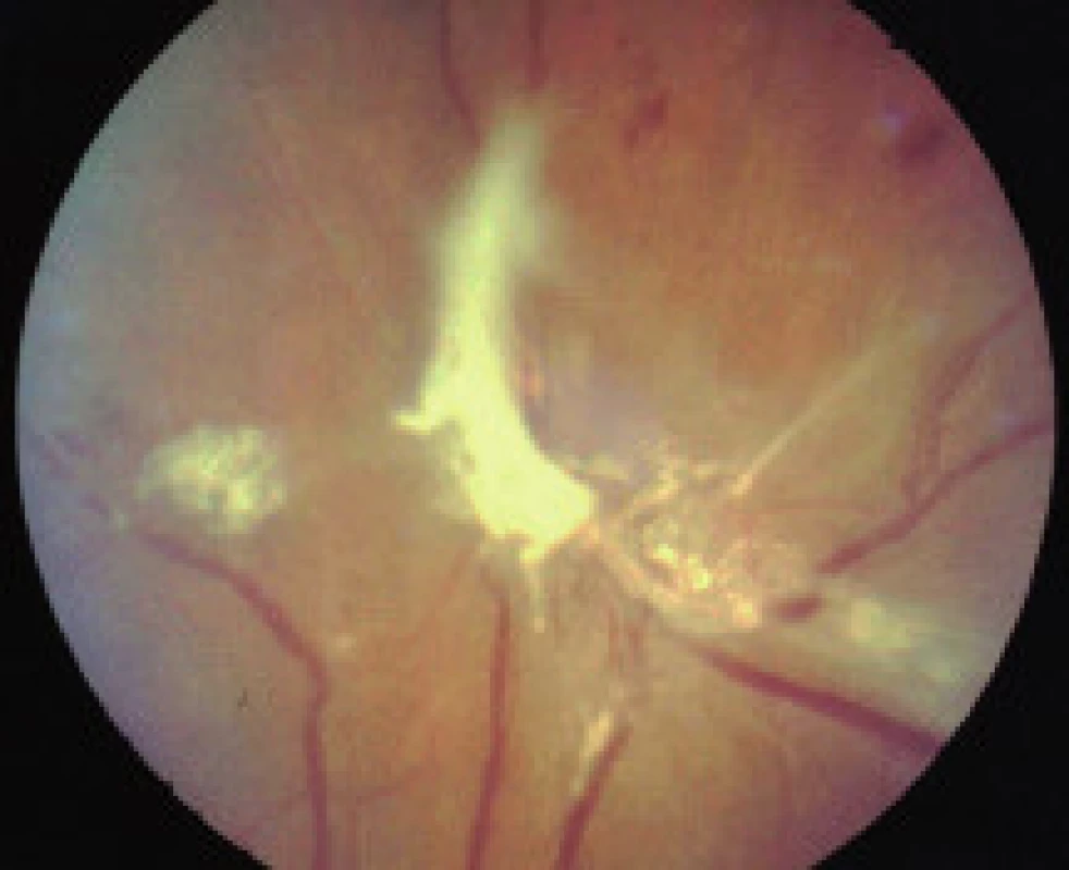 PDR – fibrovaskulárne proliferácie, pruhy